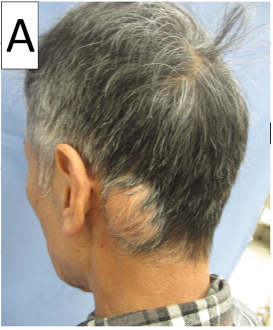 Spindle Cell Lipoma in the Posterior Neck
